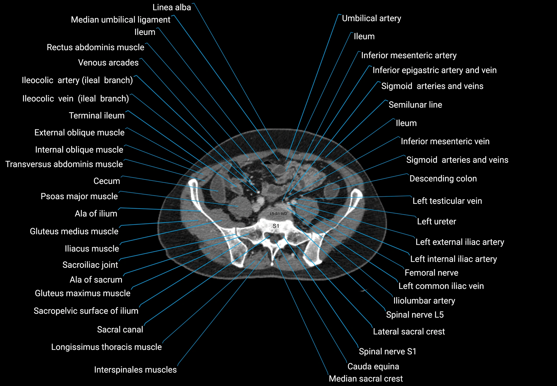 CT male pelvis axial cross sectional anatomy labelled radiology image -00137.webp